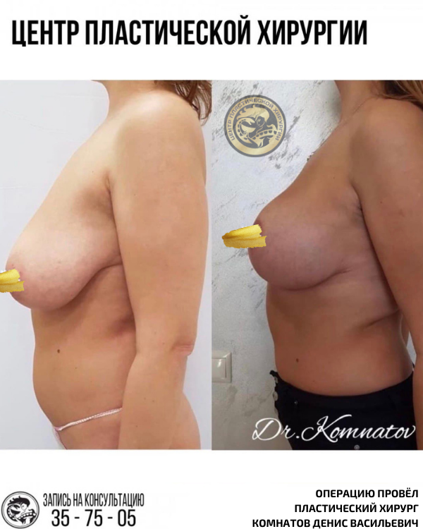 увеличение подтяжка груди импланты ассиметрия груди калининград комнатов денис васильевич