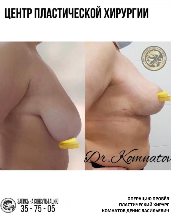 увеличение подтяжка груди импланты ассиметрия груди калининград комнатов денис васильевич