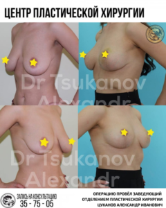 увеличение подтяжка груди импланты ассиметрия груди калининград цуканов александр иванович