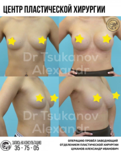 увеличение подтяжка груди импланты ассиметрия груди калининград цуканов александр иванович